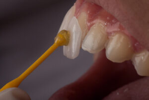 porcelain veneers before and after process pyrmont