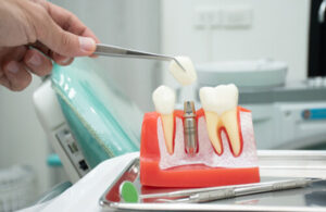 Dental Implant Thailand procedure pyrmont