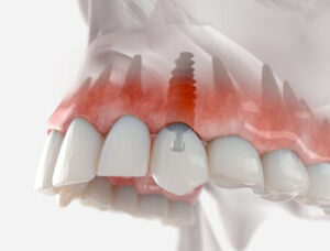 dental implant thailand illustration pyrmont