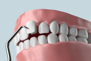 Full Set Of Veneers Cost procedure pyrmont