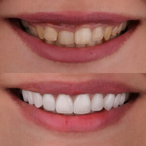 Signs Of Bad Veneers before and after