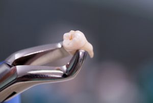 Can You Fly After Tooth Extraction removal
