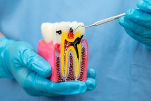 How To Remove Tooth Decay Yourself cavity