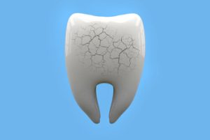 How To Remove Tooth Decay Yourself cracks