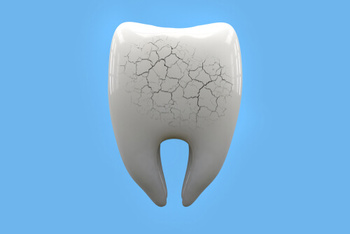 How to Remove Tooth Decay Yourself and When to Seek Help