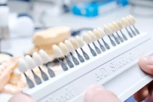 What Are Composite Veneers types