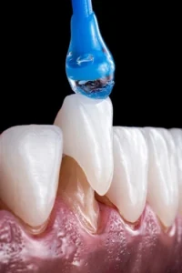 What Do Veneers Do application