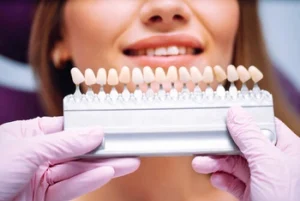 Veneers on Crooked Teeth colour