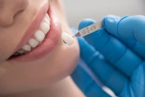 direct composite veneers application
