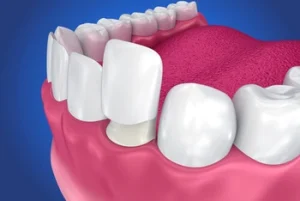 direct composite veneers porcelain