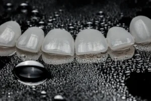 types of veneers shells
