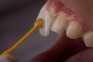 veneers being applied during the process