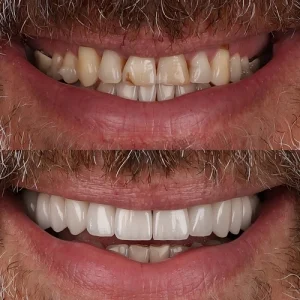 types of dental veneers results