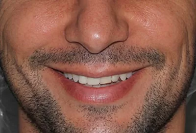 Smile before teeth whitening