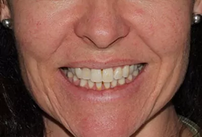 Teeth whitening before treatment