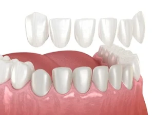 veneers shaved teeth illustration