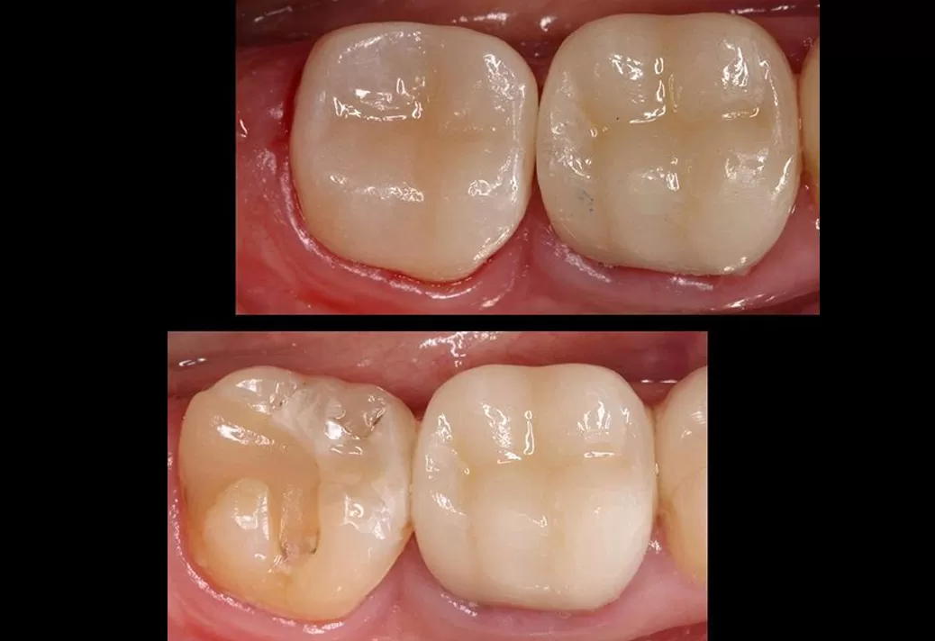 CEREC Crown Before and After