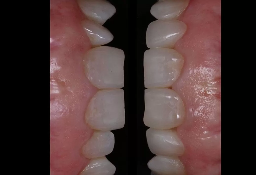 Veneer Correction