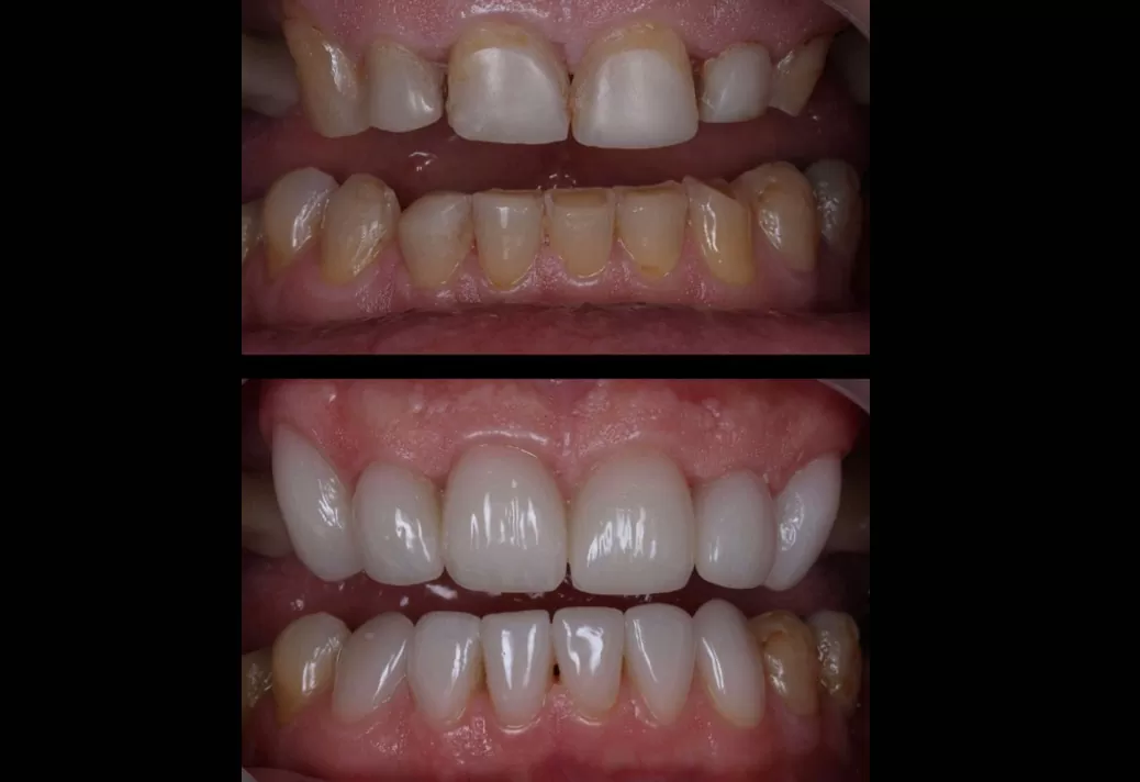 Smile Makeover Before and After