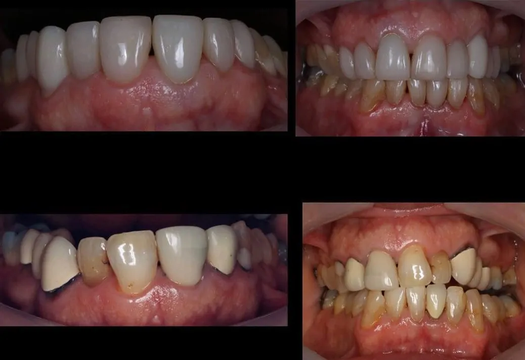 Before and After Smile Makeover