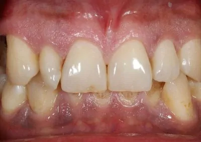 Veneers Case 1 Before