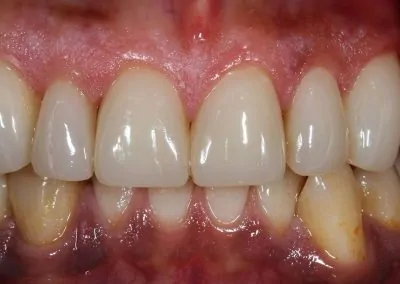 Veneers Case 1 After
