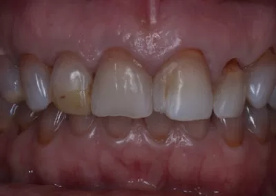 Veneers Case 2 Before