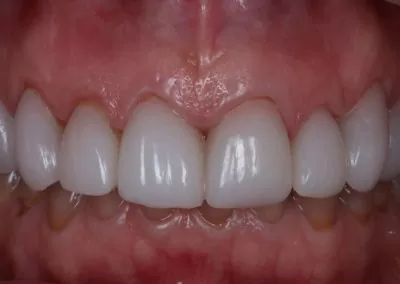 Veneers Case 2 After