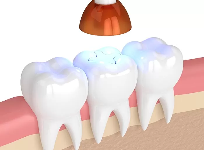 Composite Fillings