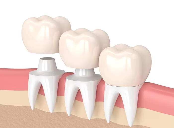 Porcelain Crowns
