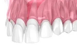 composite veneers charges pyrmont