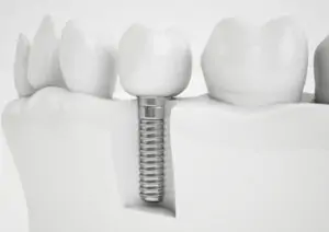 implant dentist full mouth expenses pyrmont