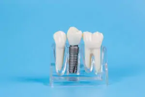 price of entire mouth implants pyrmont