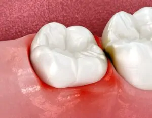 wisdom teeth pain infected